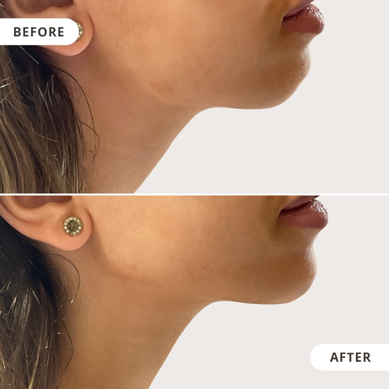 Jaw Correction